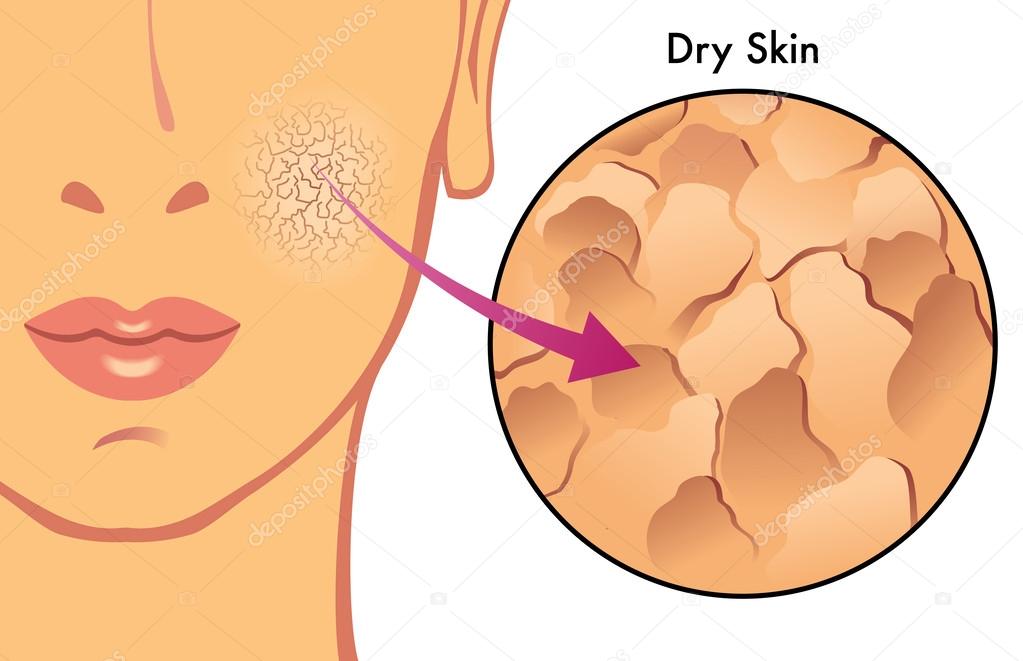 Remedies For Dry Skin