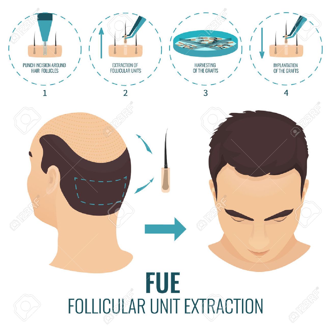 FUE hair transplant with us