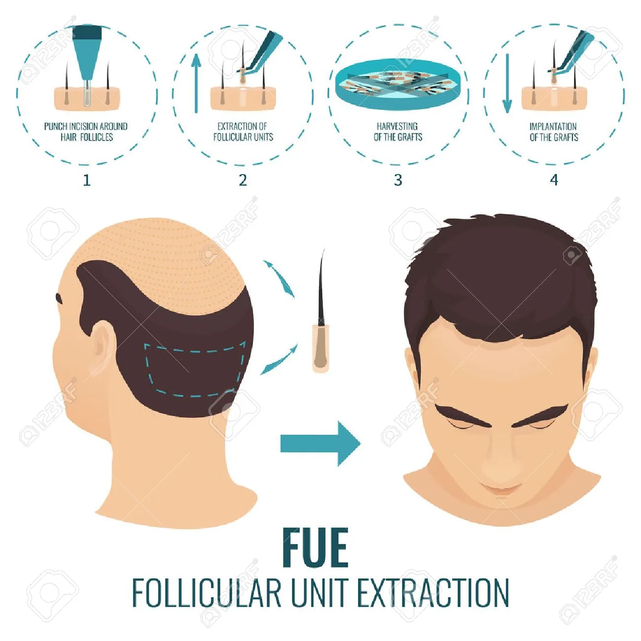 FUE hair transplant with us