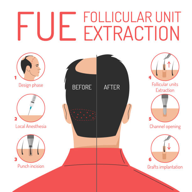 FUE Hair Transplant: The Ultimate Solution for Hair Loss at Lejeune Medspa