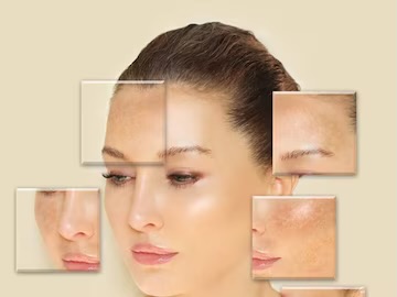 How to Treat Hyperpigmentation and Uneven Skin Tone