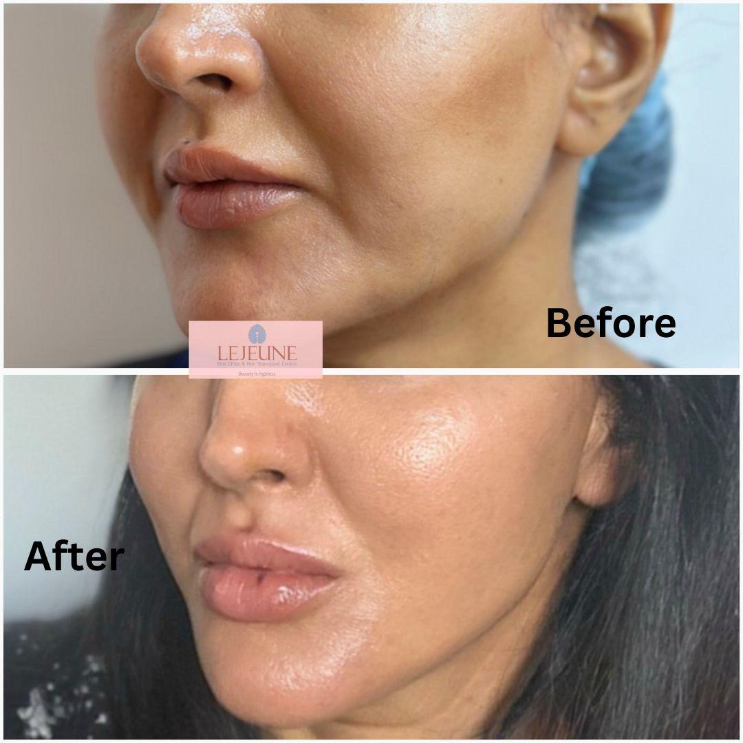 APTOS Thread Lifting: The Future of Non-Surgical Rejuvenation