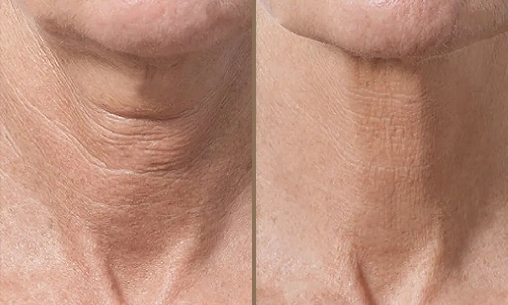 Profhilo for Neck Rejuvenation: Turn Back Time with a Smoother, Firmer Neck