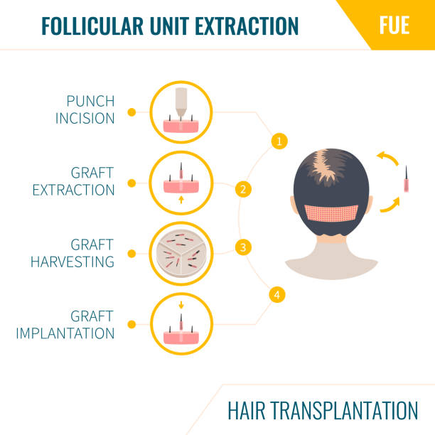 9-Hour FUE Hair Transplant Journey at LeJeune Medspa, Bangalore