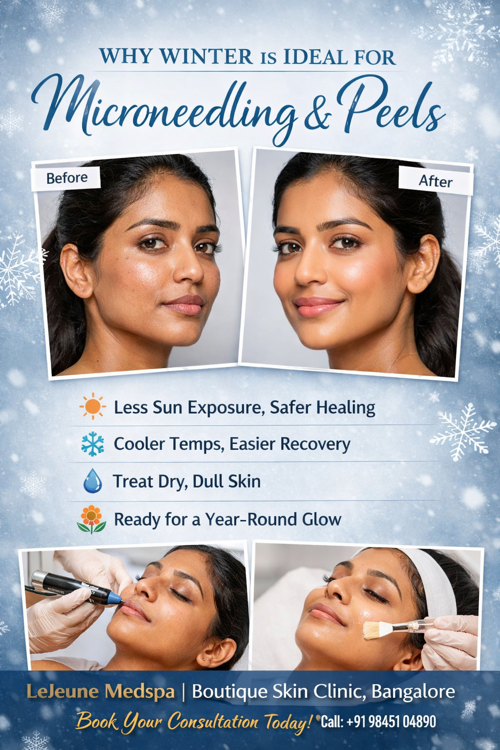 Why Winter Is Ideal for Microneedling & Peels