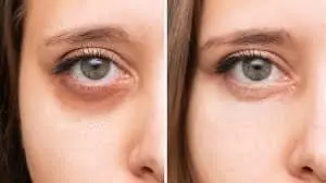 Refresh Your Look: Say Goodbye to Tired Eyes with Jalupro Young Eye