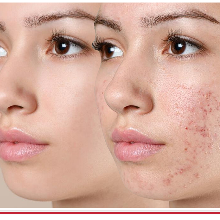 Acne Treatments