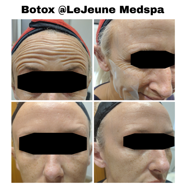 botox