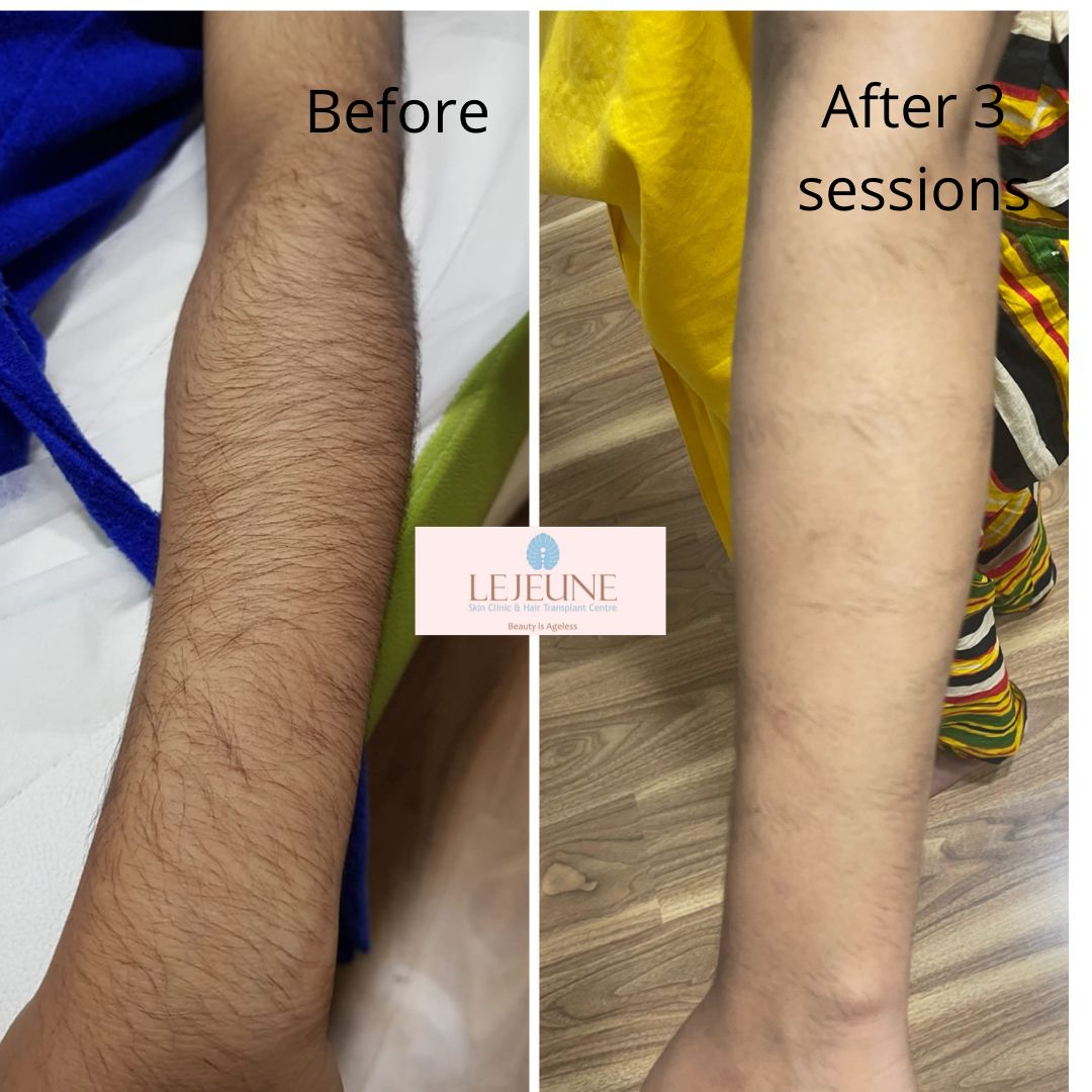 Laser Hair Removal in Bangalore & Hyderabad | LeJeune Med Spa